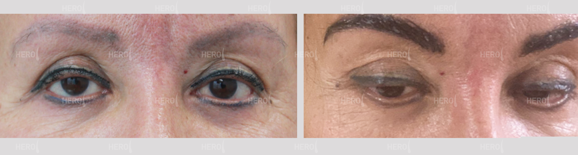 Two side-by-side images of eyes. The left image shows both eyes open, the right shows an eye drooped.