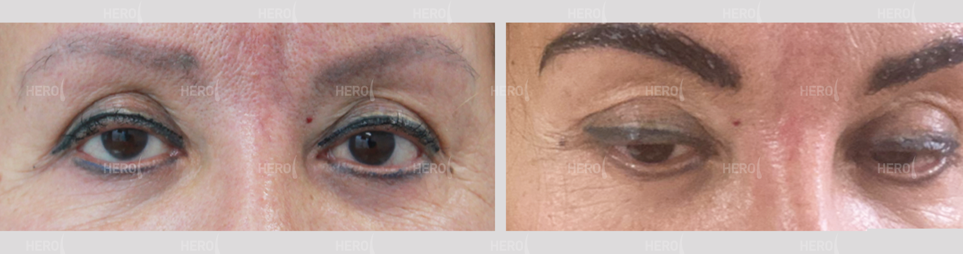 Dos pares de ojos, un par abierto, el otro con un ojo parcialmente cerrado y el otro completamente cerrado.