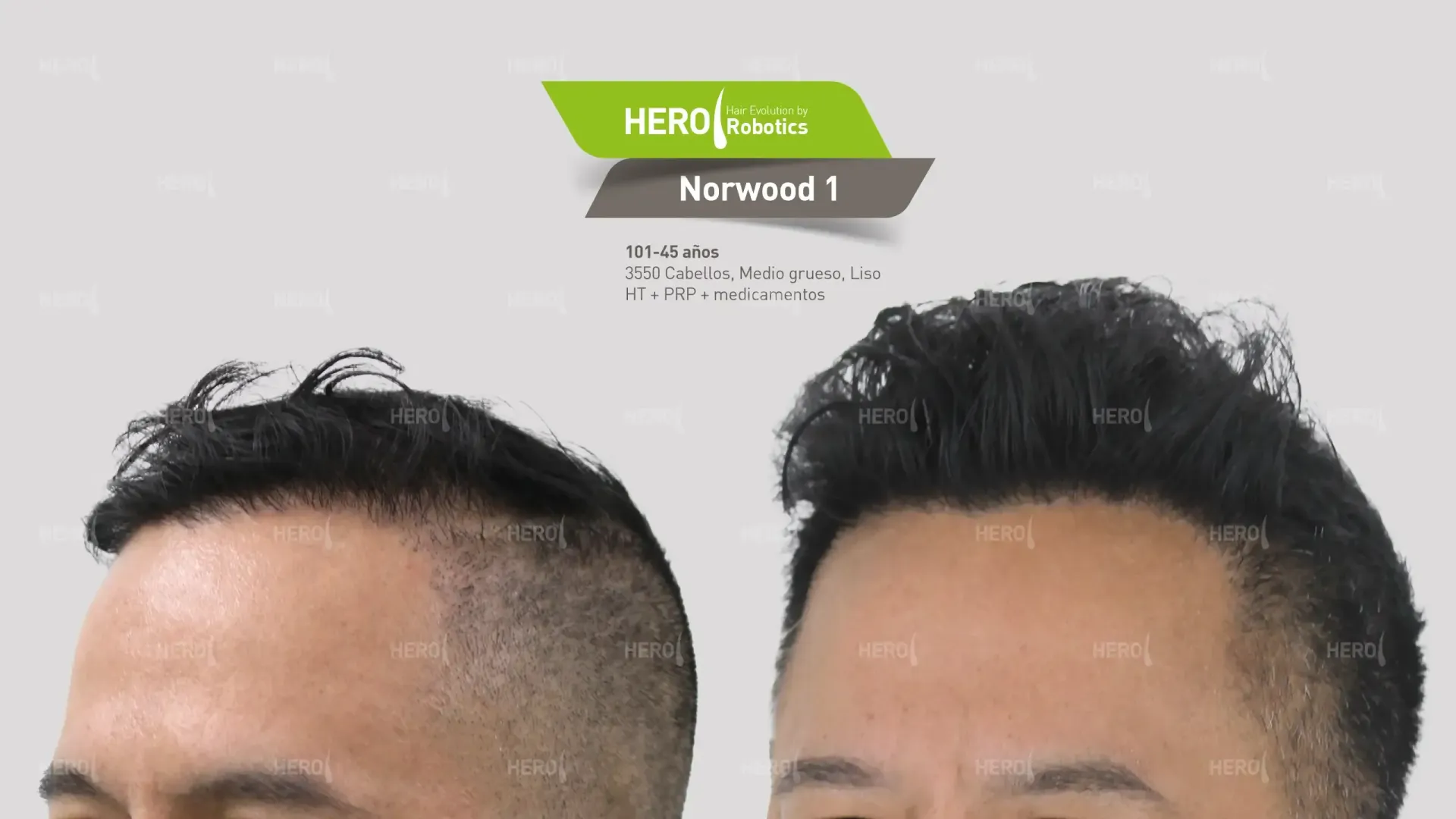 Se muestra la cabeza de un hombre antes y después de un trasplante de cabello. Norwood 1