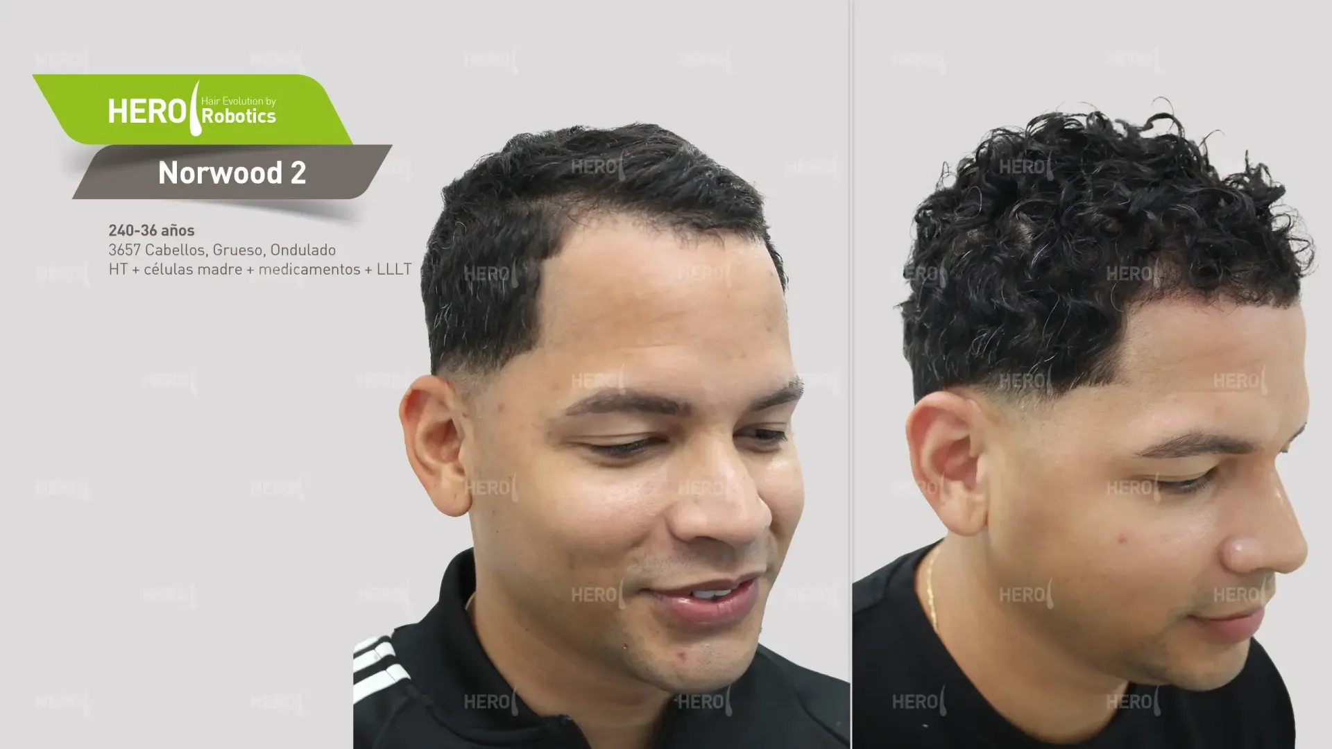 Una foto de antes y después del cabello de un hombre Norwood 2.