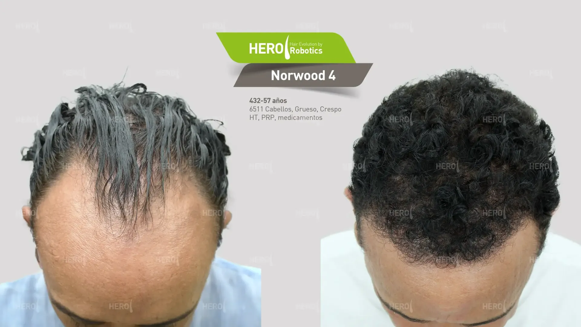 A before and after picture of a man 's hair
