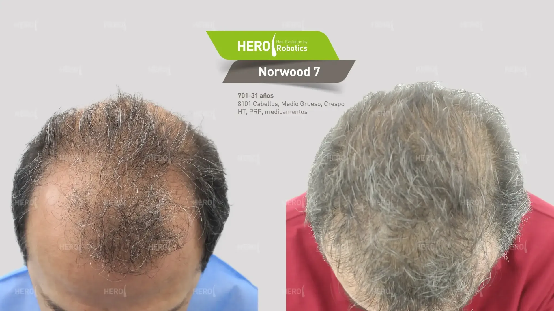 A before and after picture of a man's hair loss Norwood 7