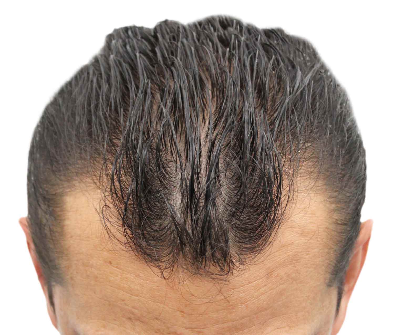 Male with great hair loss