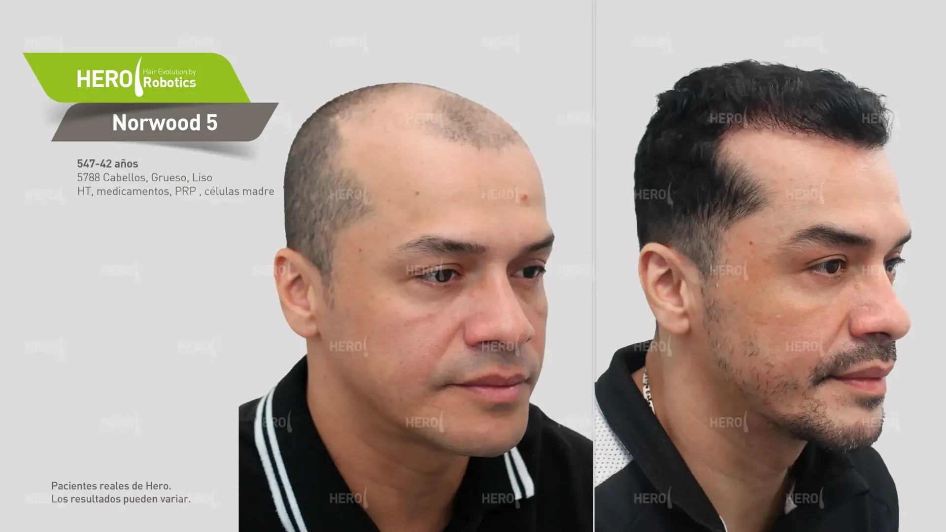 Una foto de antes y después del cabello de un hombre Norwood 5.