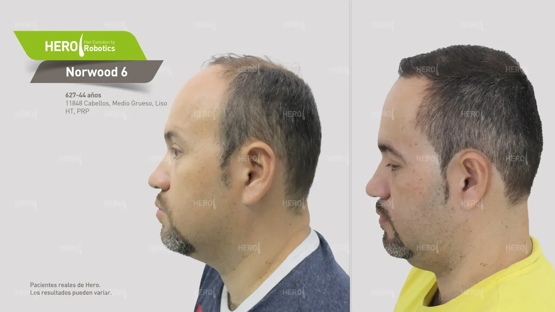 A before and after hair transplant photo of a man 's hair alopecia level Norwood 6