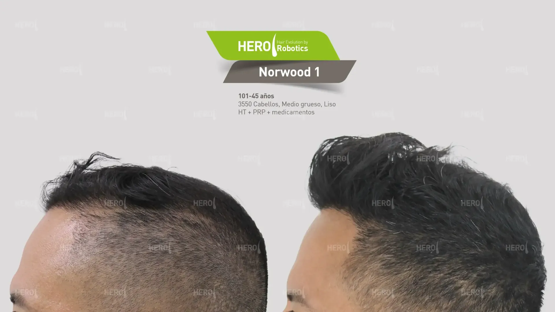 Se muestra la cabeza de un hombre antes y después de un trasplante de cabello. Norwood 1