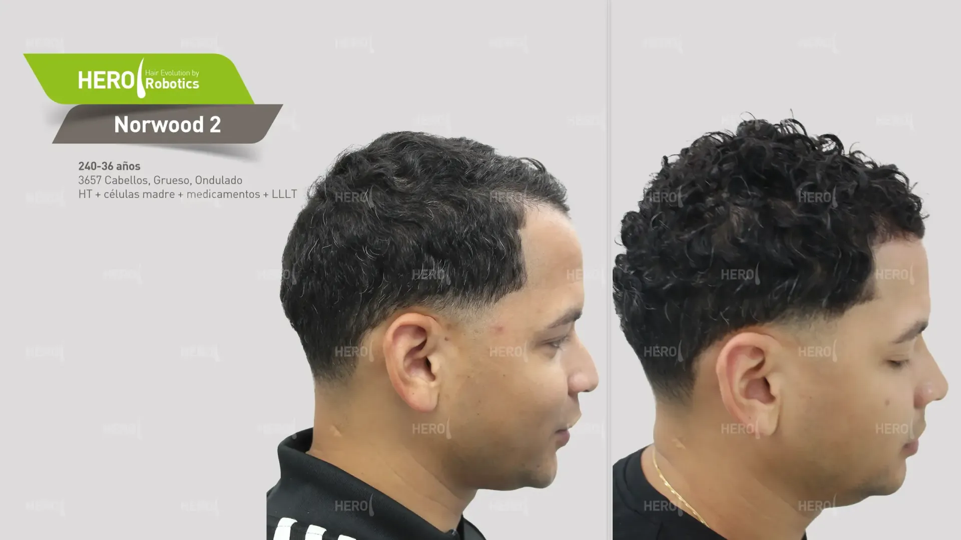 Una foto de antes y después del cabello de un hombre Norwood 2.