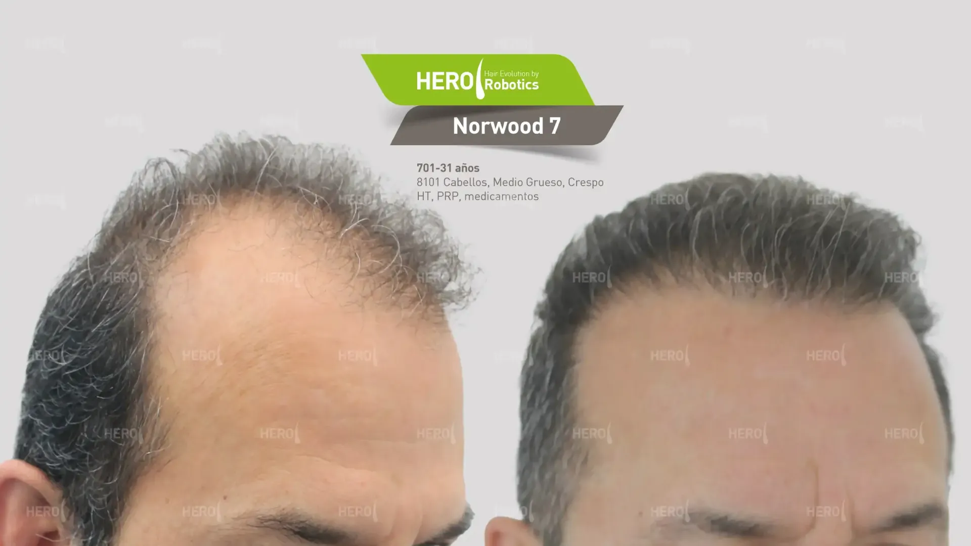 A man 's head is shown before and after a hair transplant.