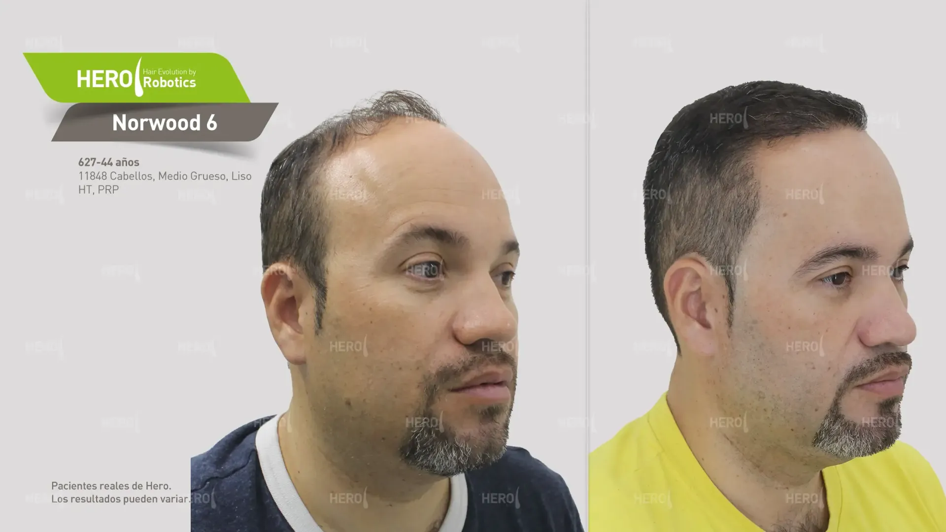 A before and after hair transplant photo of a man 's hair alopecia level Norwood 6