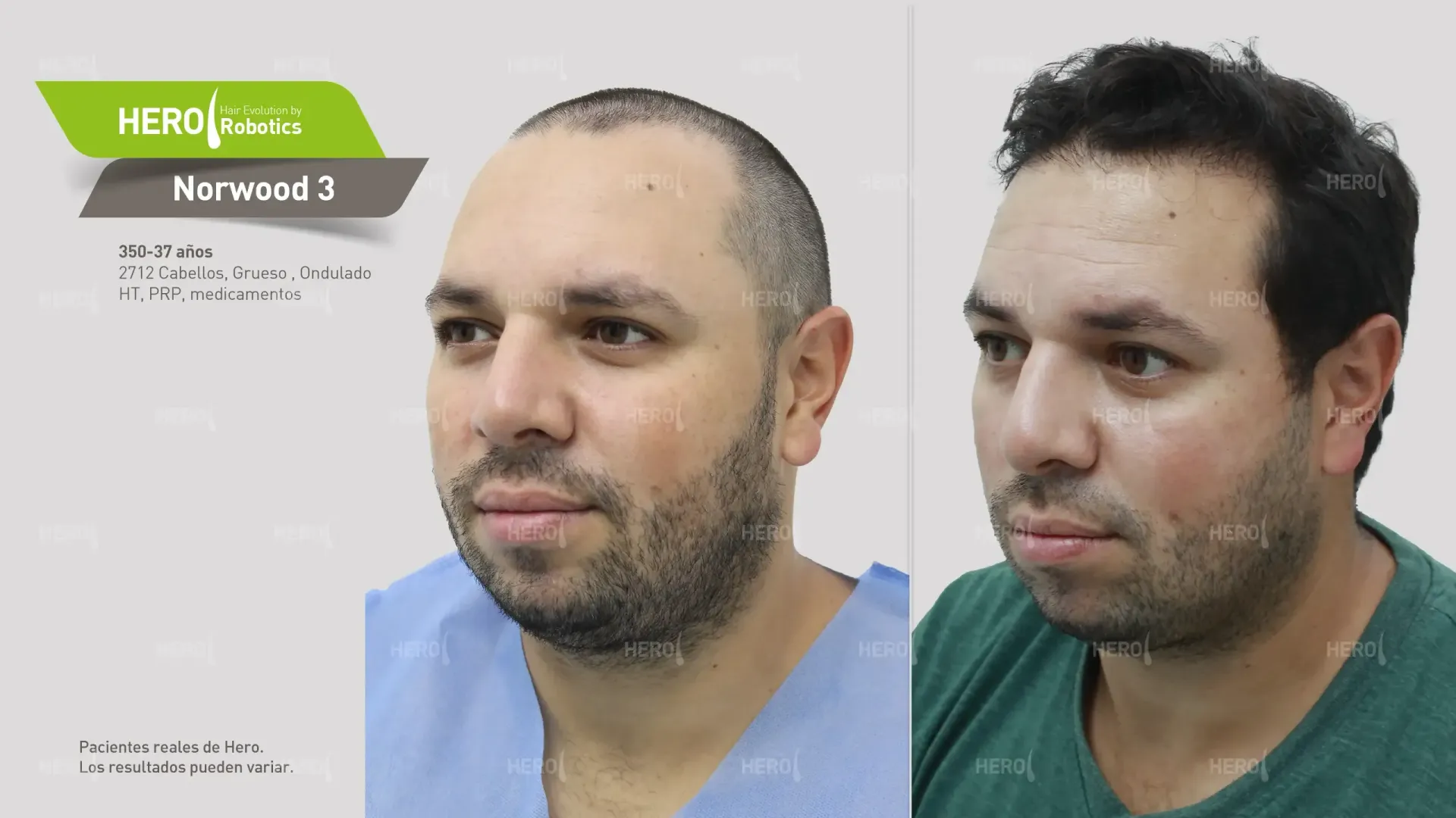 A before and after photo of a man's head Norwood 3
