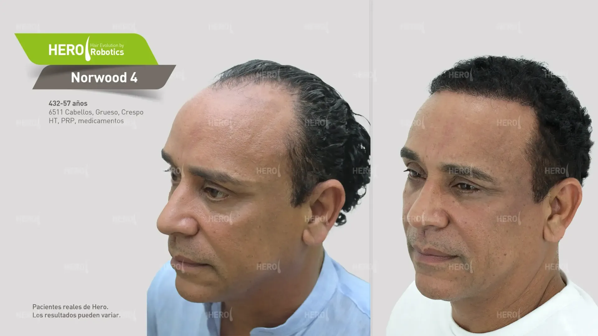 Una fotografía de antes y después del crecimiento del cabello de un hombre Norwood 4.