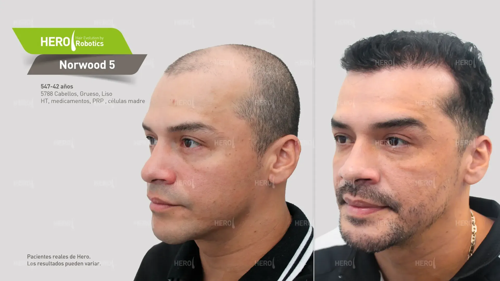 A before and after photo of a man 's hair alopecia level Norwood 5