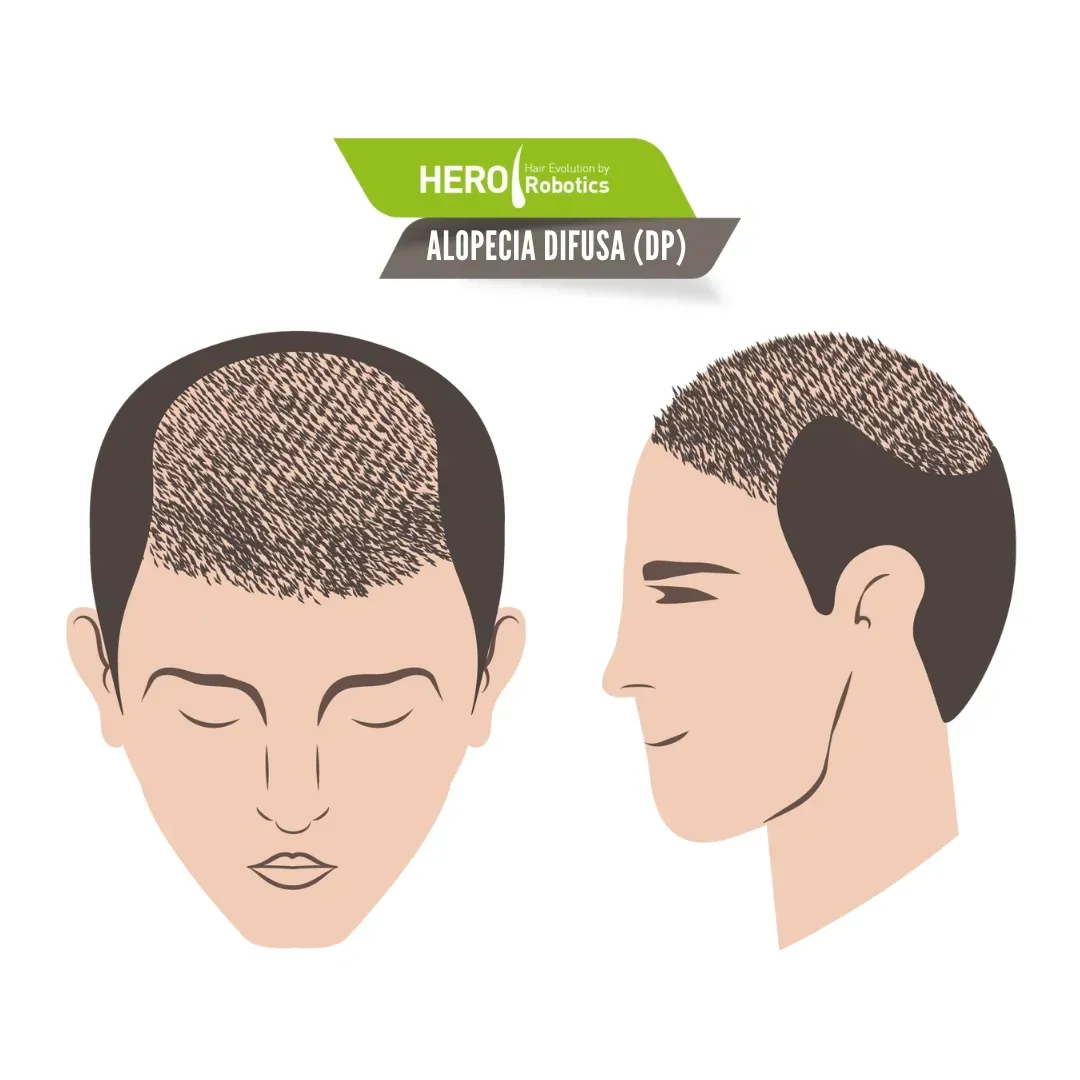 Alopecia Difusa: Causas y Tratamientos Efectivos para la Caída de Cabello