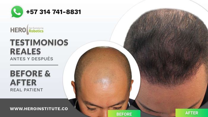 Before and after | Testimonios reales