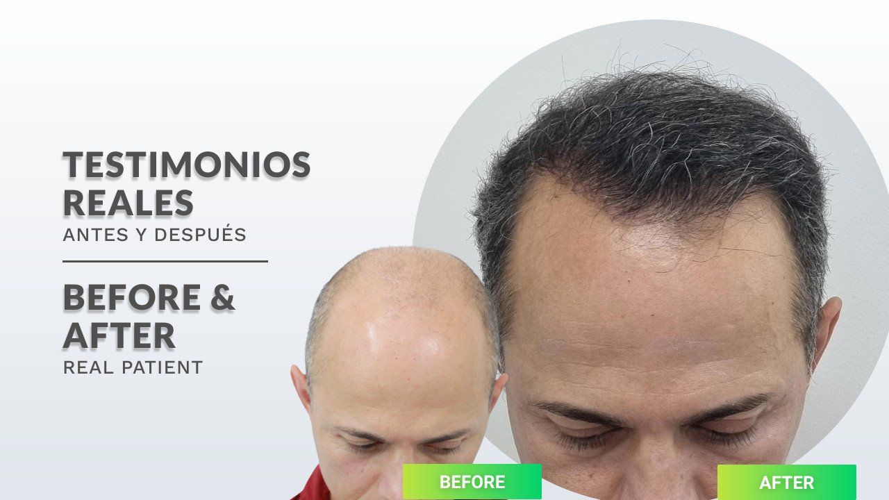 Se muestra la cabeza de un hombre antes y después de un trasplante de cabello.