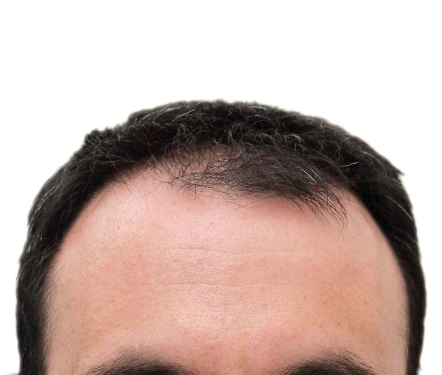 Before hair restoration | Real patient, results may vary per individual