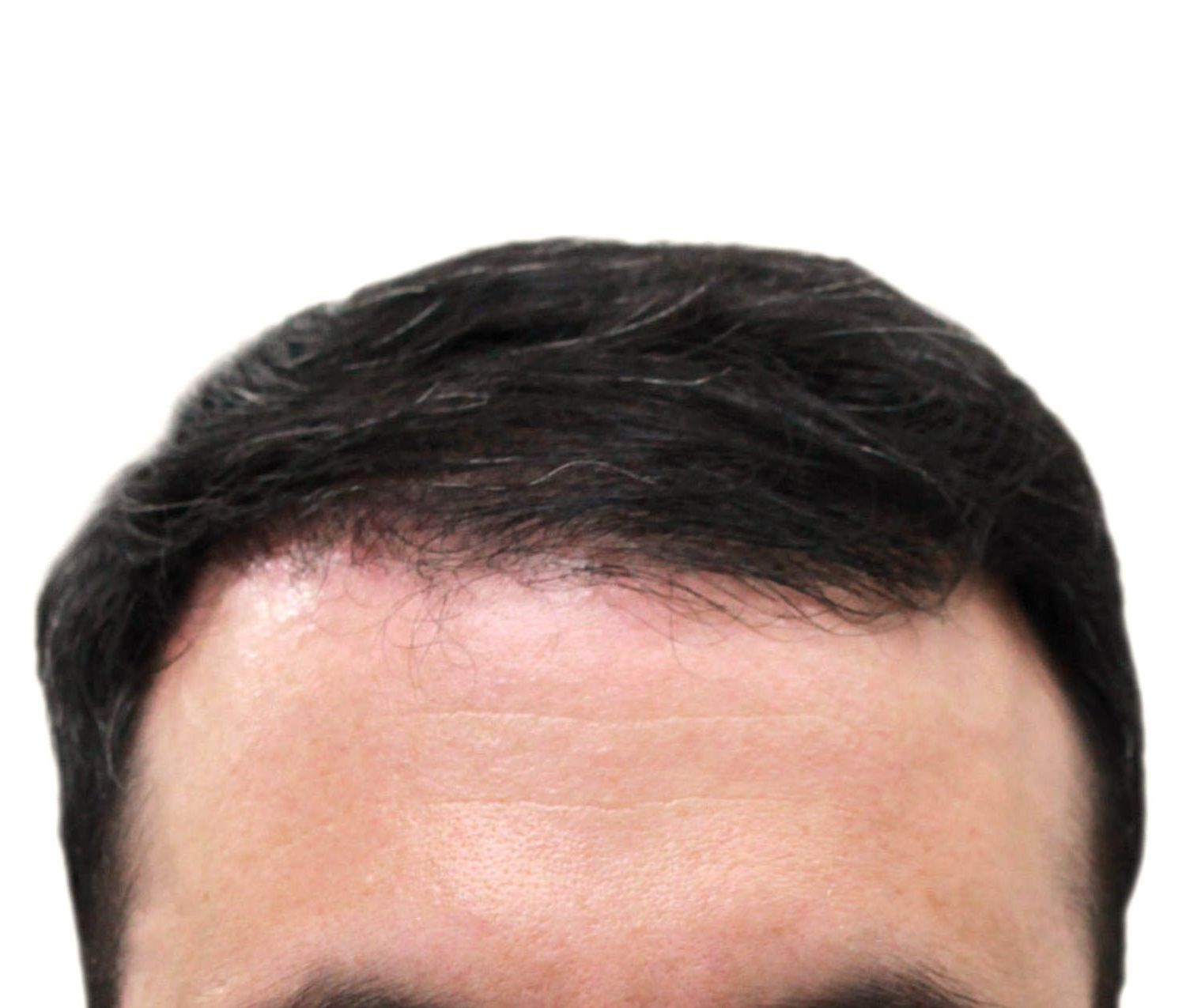 After hair restoration | Real patient, results may vary per individual