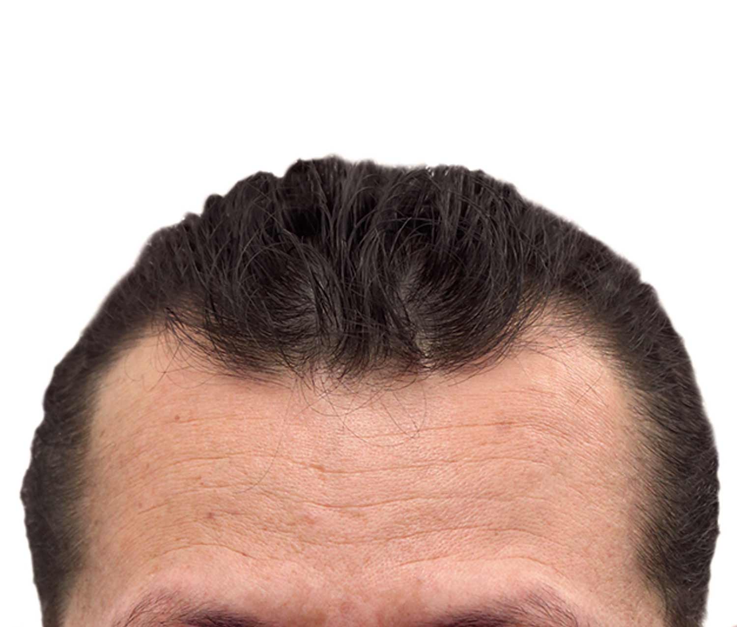 Before hair restoration real patient