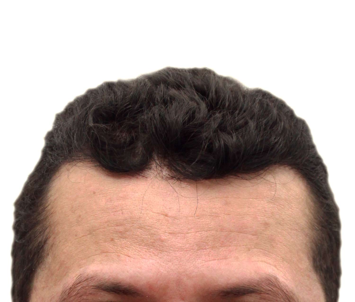 After hair restoration real patient