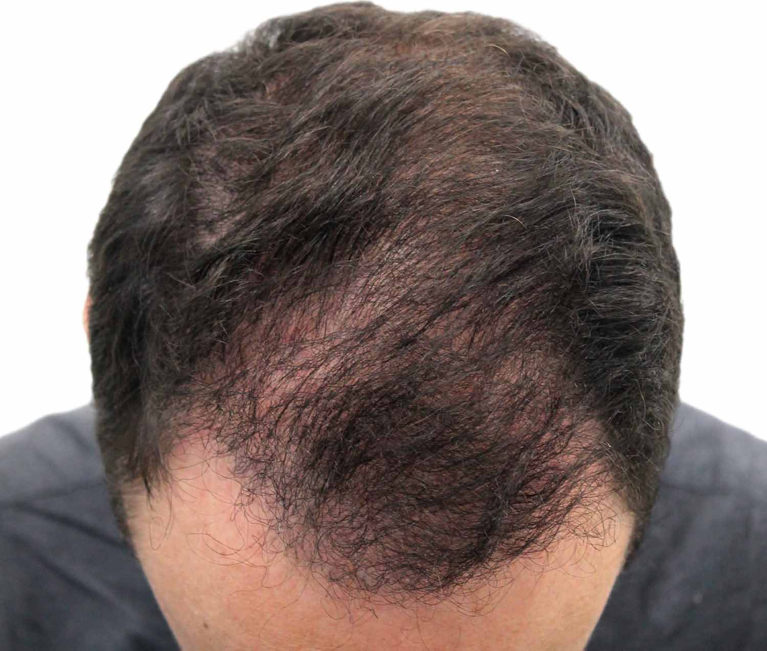 After hair restoration | Real patient, results may vary per individual