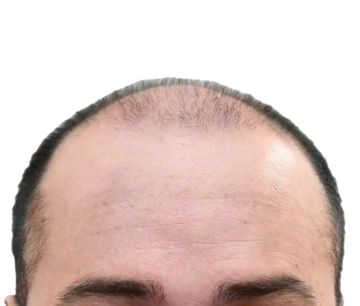 Antes de trasplante capilar | Paciente real Resultado Real