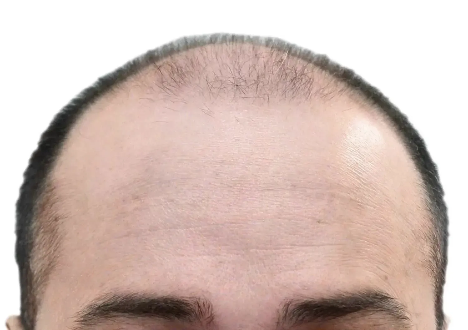 A person's balding scalp, with thin hair at the top and forehead.