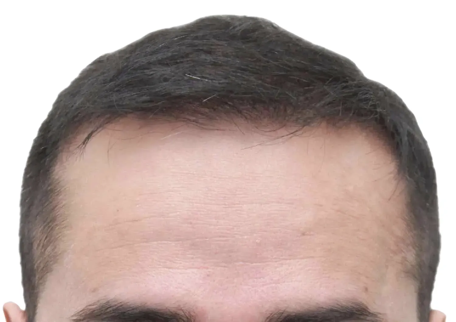 Close-up of a person's forehead and hairline; dark brown hair; slight receding hairline.