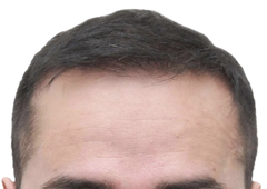 Close-up of a person's forehead and hairline; dark brown hair; slight receding hairline.