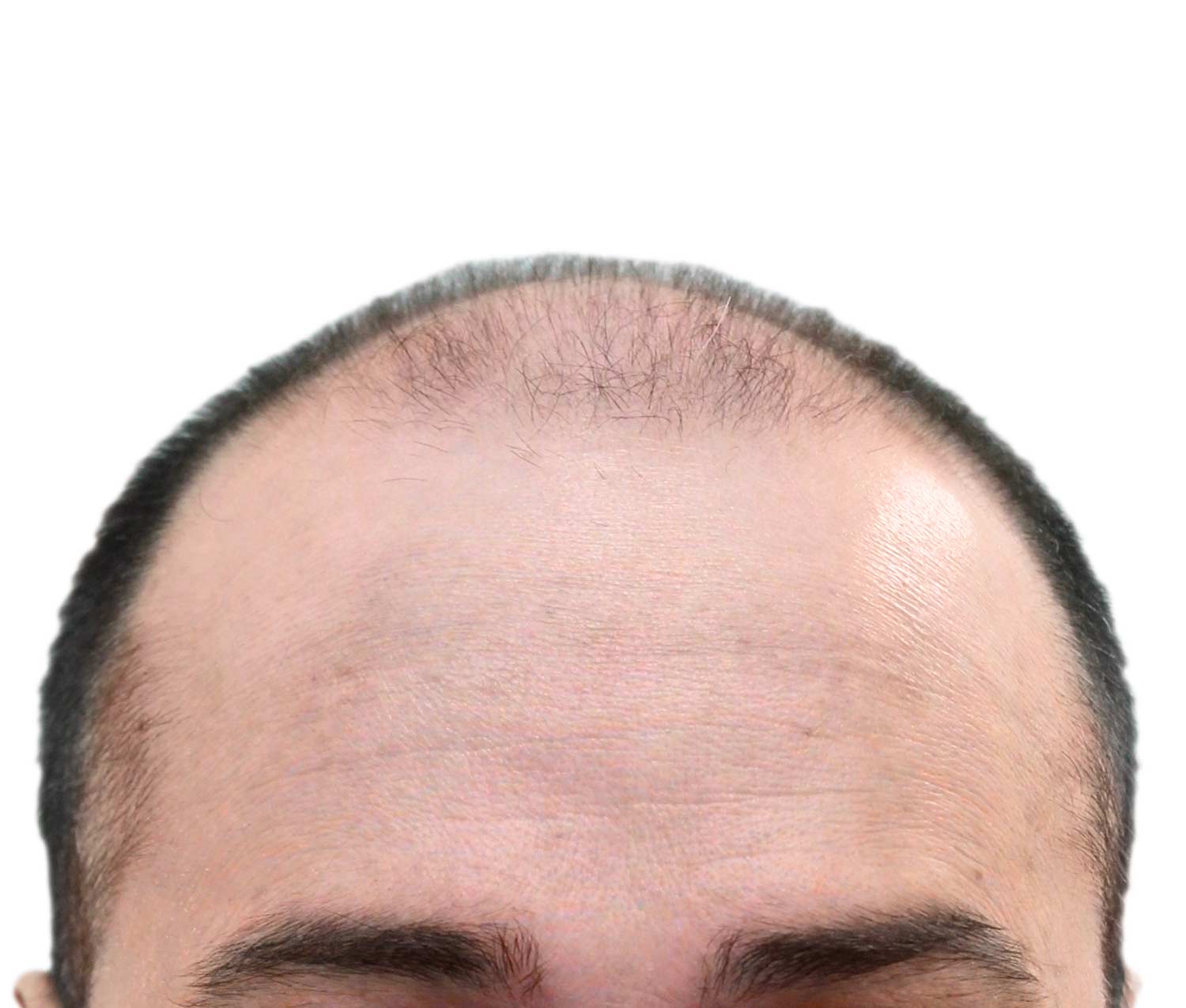 Before hair restoration | Real patient, results may vary per individual