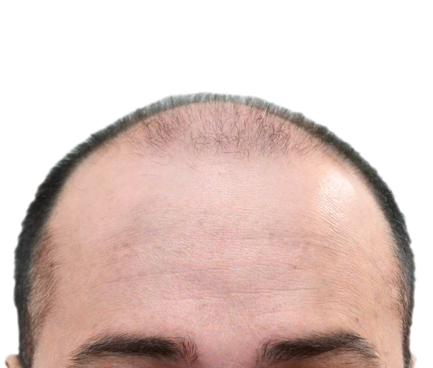 Before Hair Restoration