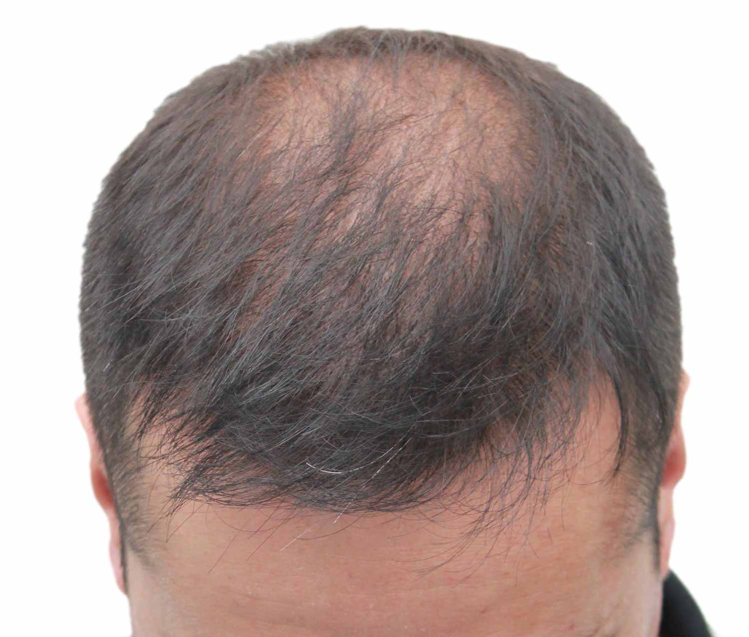 a close up of a man 's head after hair transplant