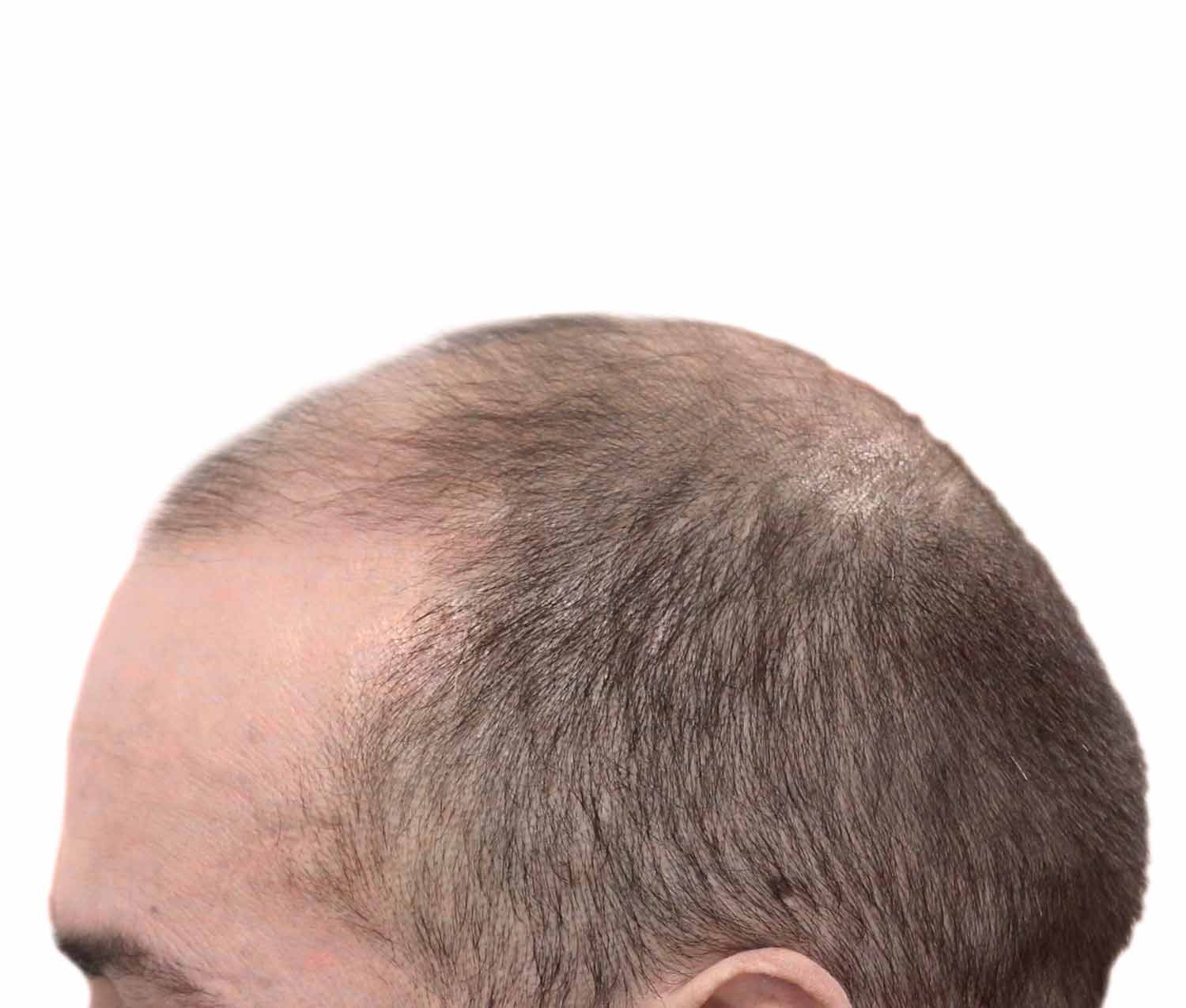a close up of a man 's head with a bald head .