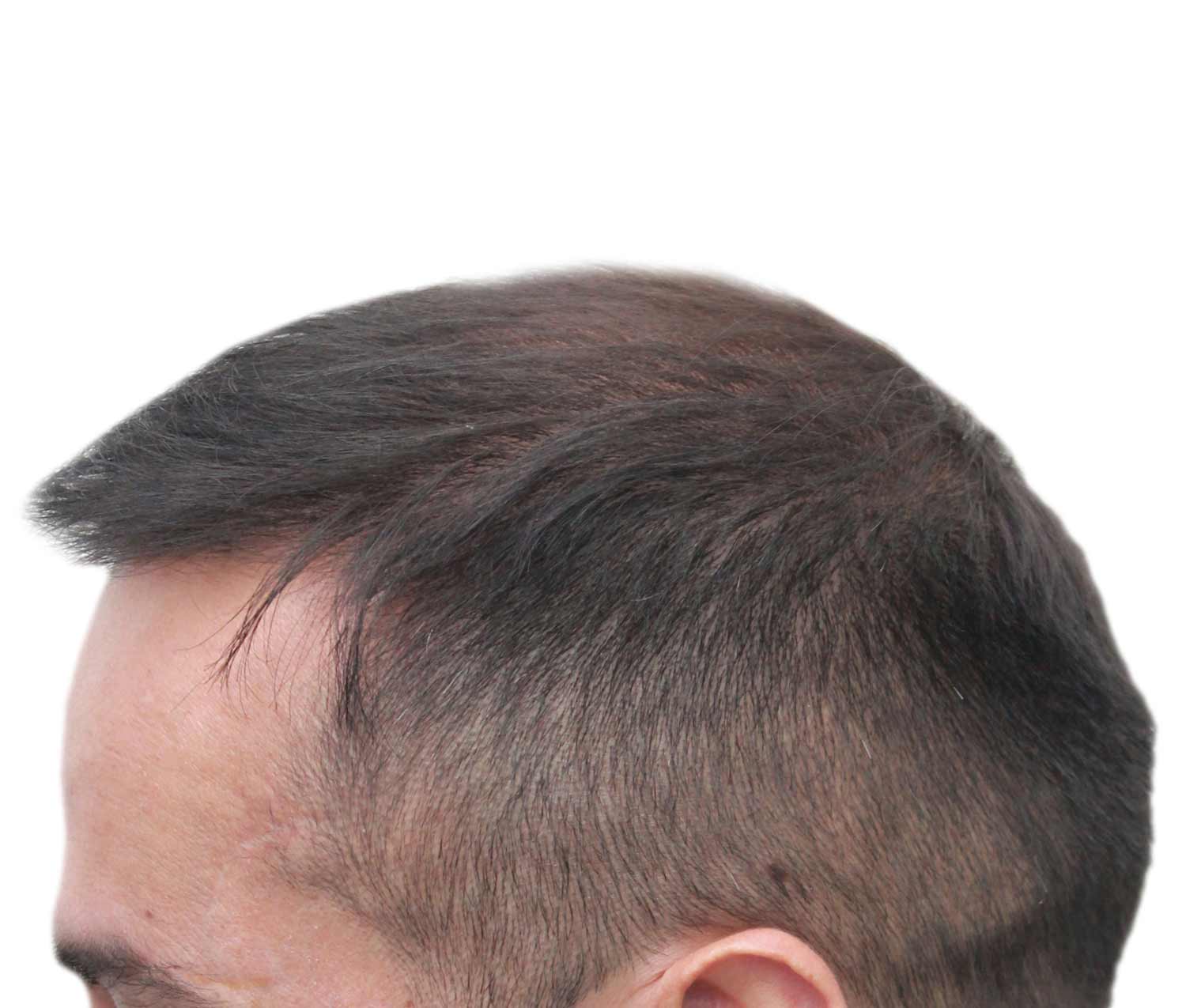 a close up of a man 's head after hair transplant on a white background .