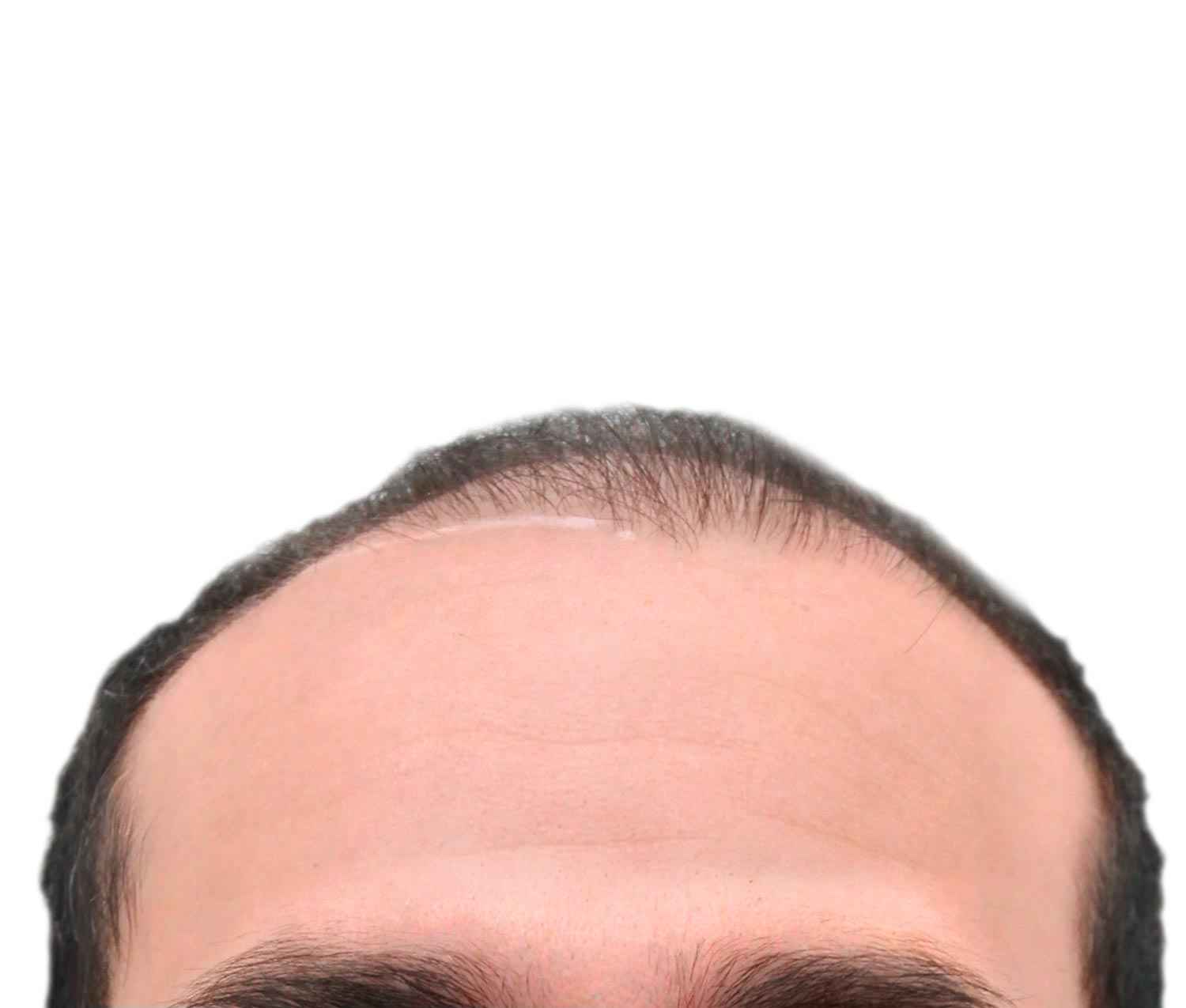 Before hair restoration | Real patient, results may vary per individual