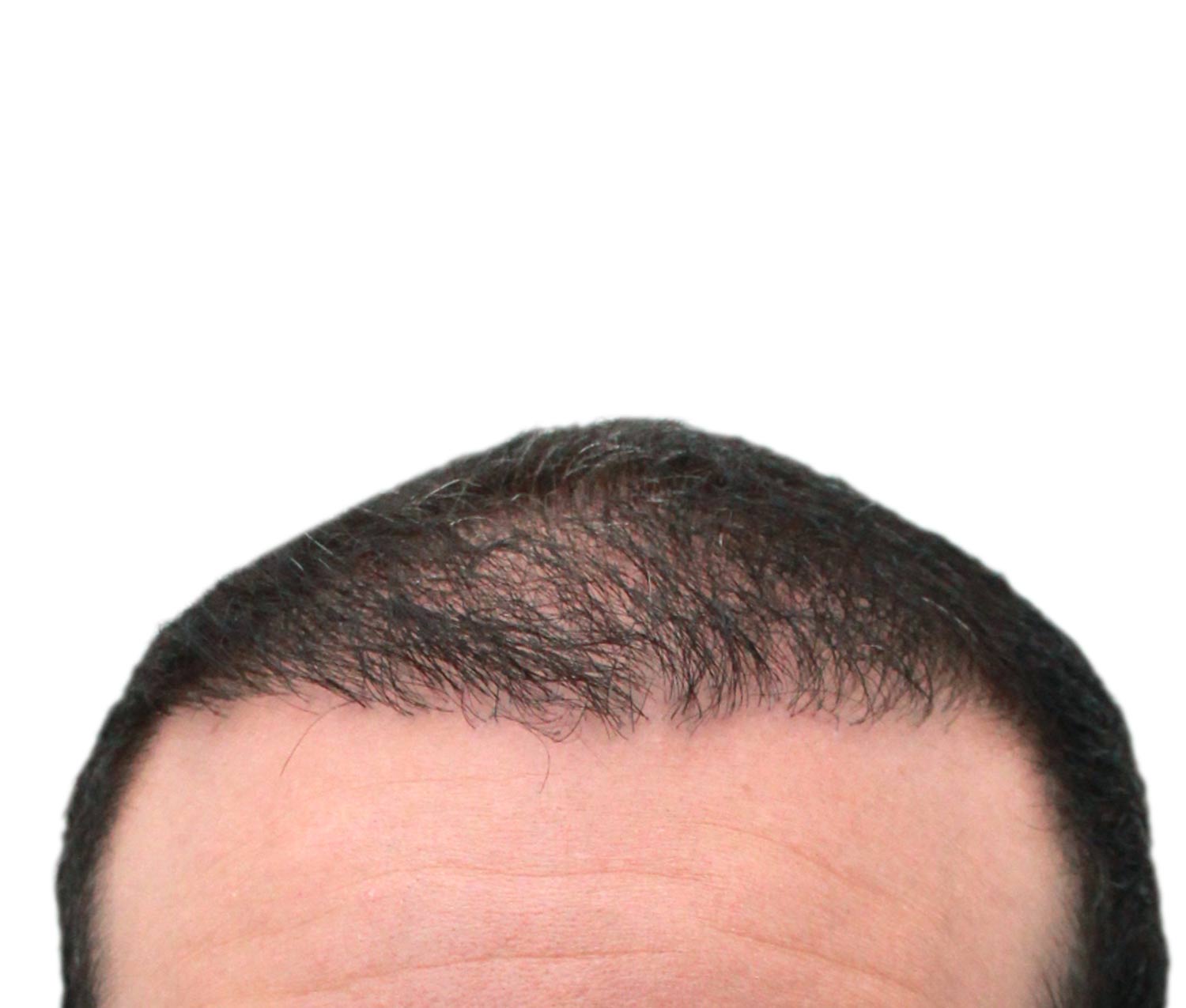 After hair restoration | Real patient, results may vary per individual