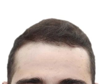 a close up of a man 's forehead with a white background .