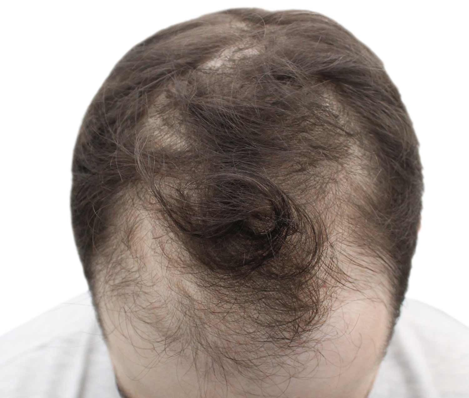 a close up of a man 's head with a bald spot on it .