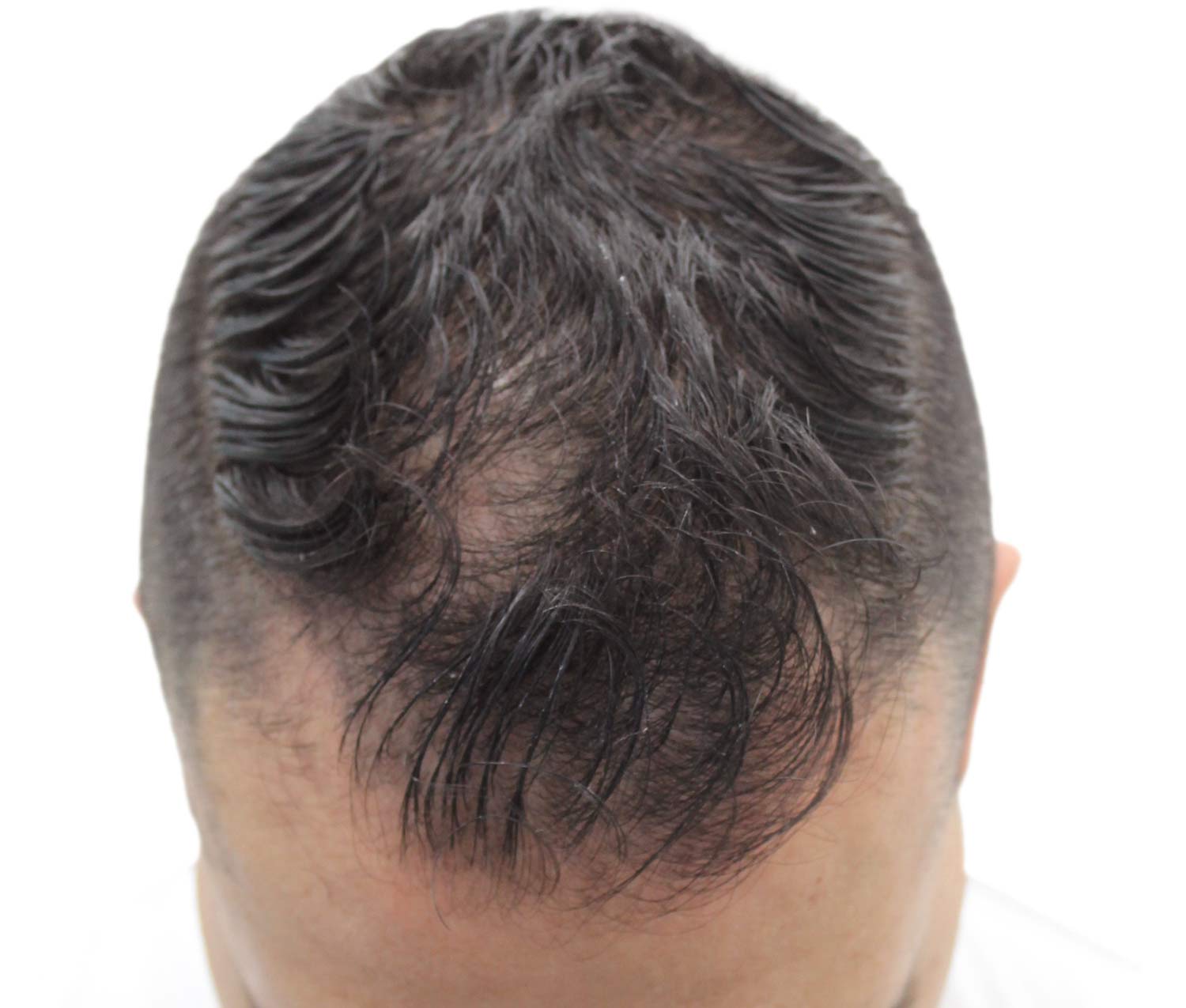 a close up of a man 's head with a bald spot on it .
