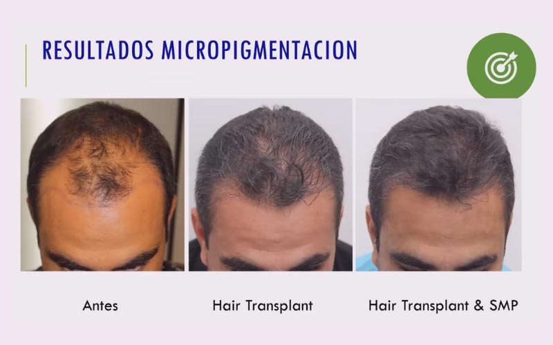 three pictures of a man 's head before and after hair transplant .