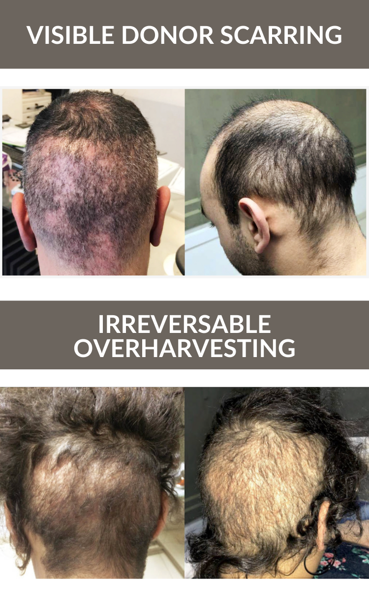 Hair Transplant Complications: What Is Over-Harvesting?