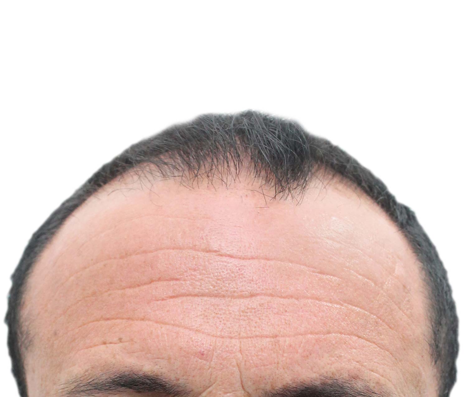 Antes del injerto de cabello | Paciente real. Los resultados individuales pueden variar.