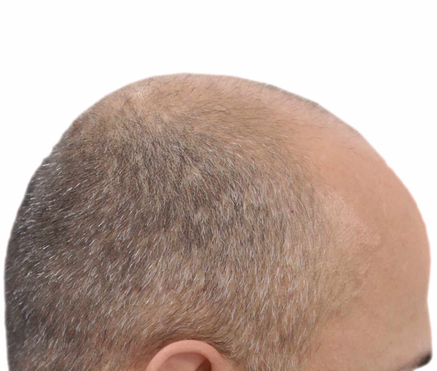a close up of a man 's head with a bald head