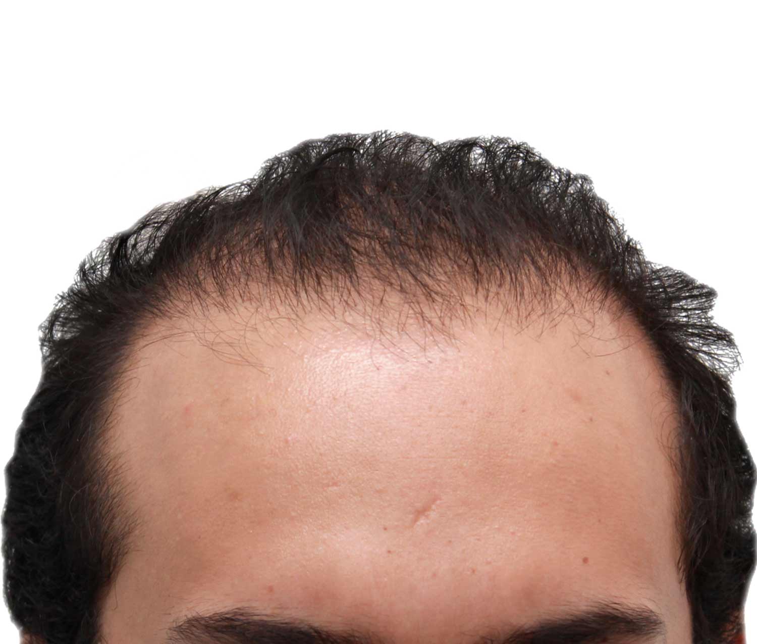 Men before hair transplant