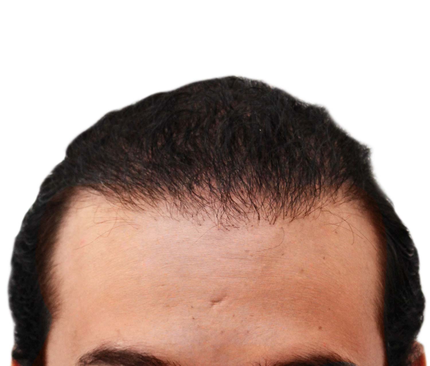 Men After hair transplant