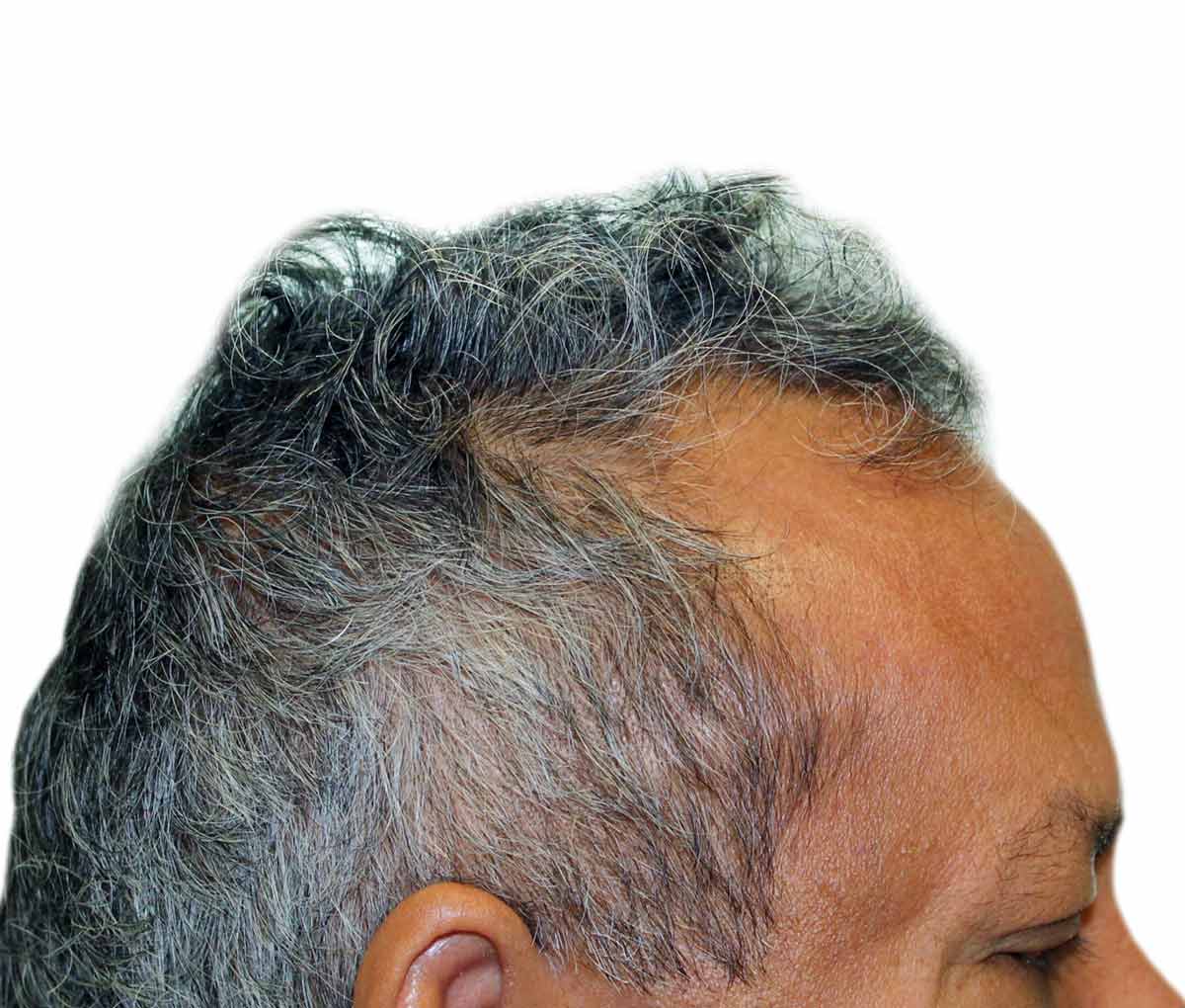 un primer plano de la cabeza de un hombre con cabello gris sobre un fondo blanco.