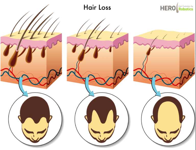 a diagram showing the stages of hair loss