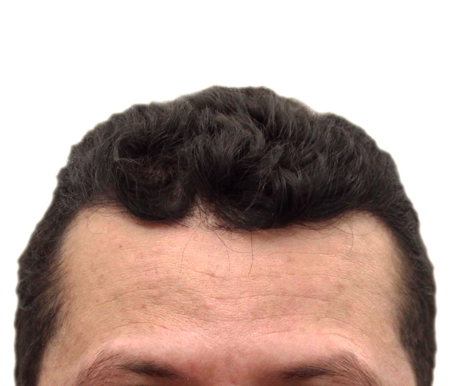 Después del injerto de cabello | Paciente real. Los resultados individuales pueden variar.
