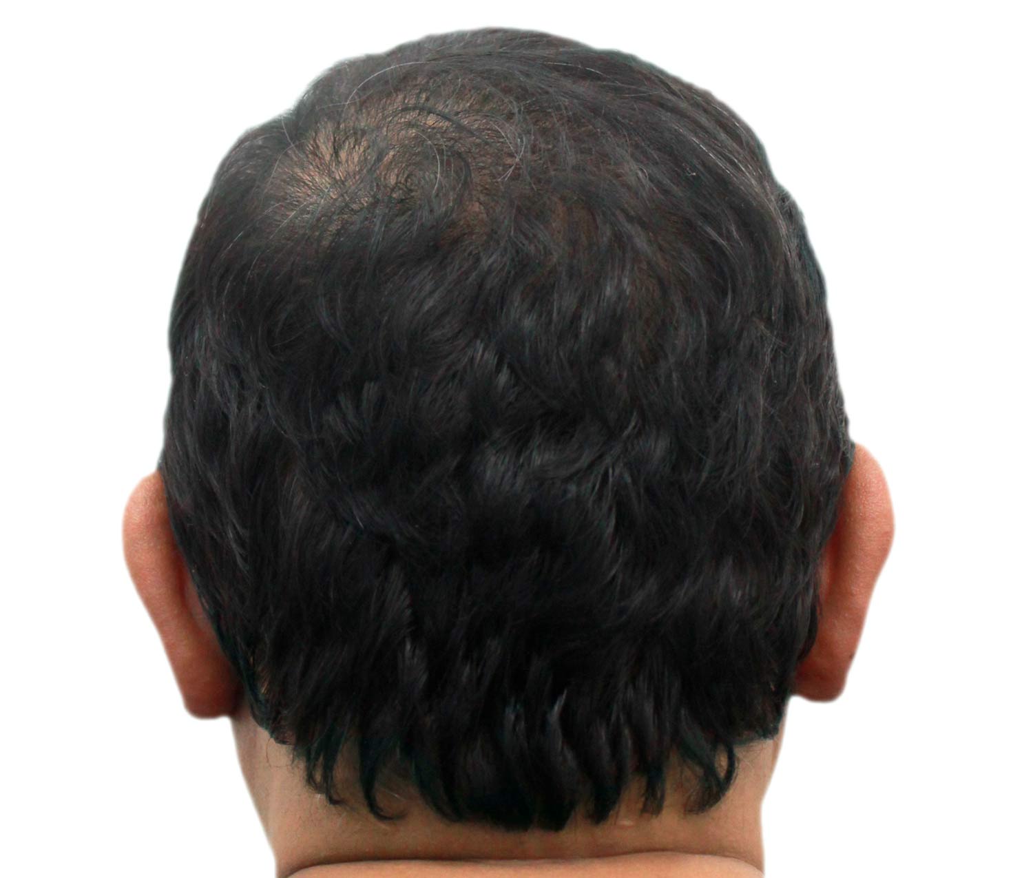 Después del injerto de cabello | Paciente real. Los resultados individuales pueden variar.
