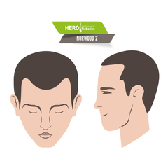 Understanding Norwood Level 2 Hair Loss in 2024
