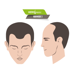 Norwood Level 3: Early Stage Hair Thinning in Men